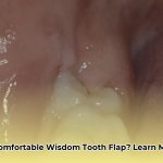 operculum_dental_edited