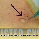 sebaceous_cyst_in_the_scrotum_edited