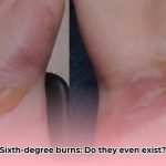 sixth_degree_burn_edited