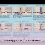 what_does_abnormal_ecg_mean_edited